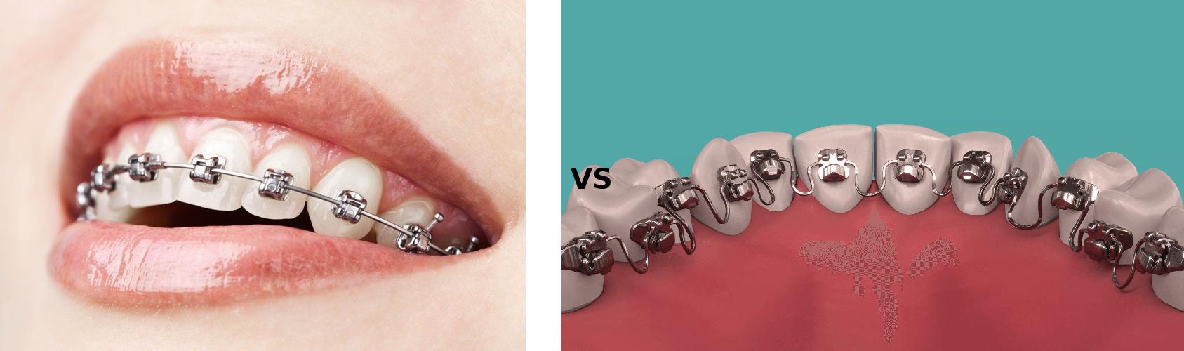 Traditional Braces vs. Lingual Braces: Choosing the Right Orthodontic Treatment