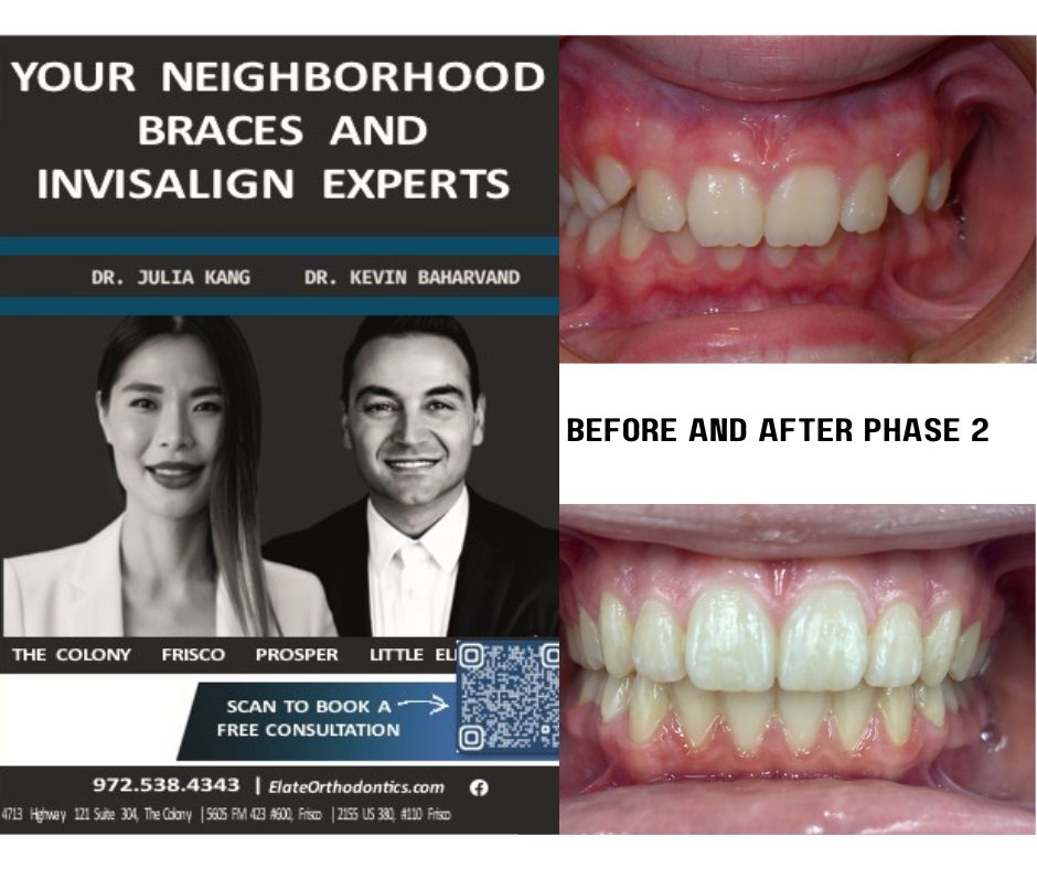 Overbite-overjet-braces-invisalign-angel-aligners