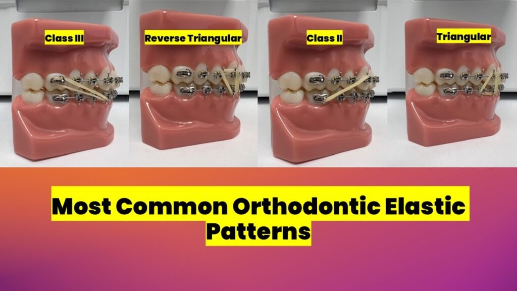 Most common orthodontic rubber band patterns