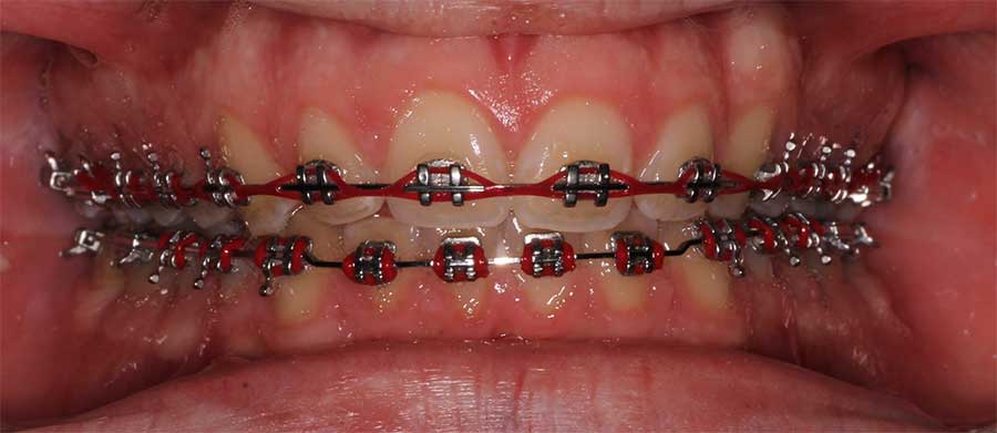 power chain braces Elate Orthodontics