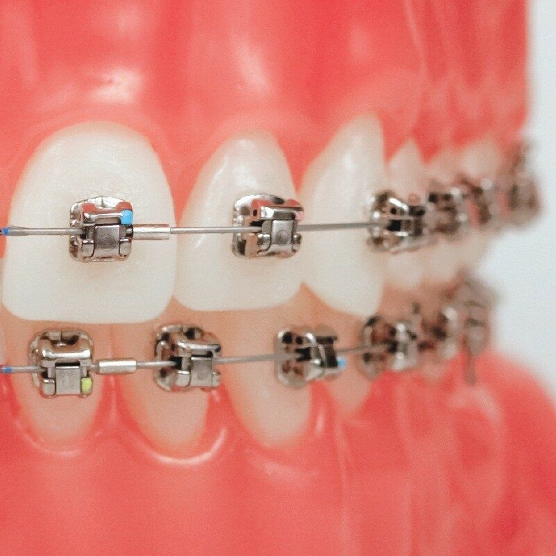 Damon Braces