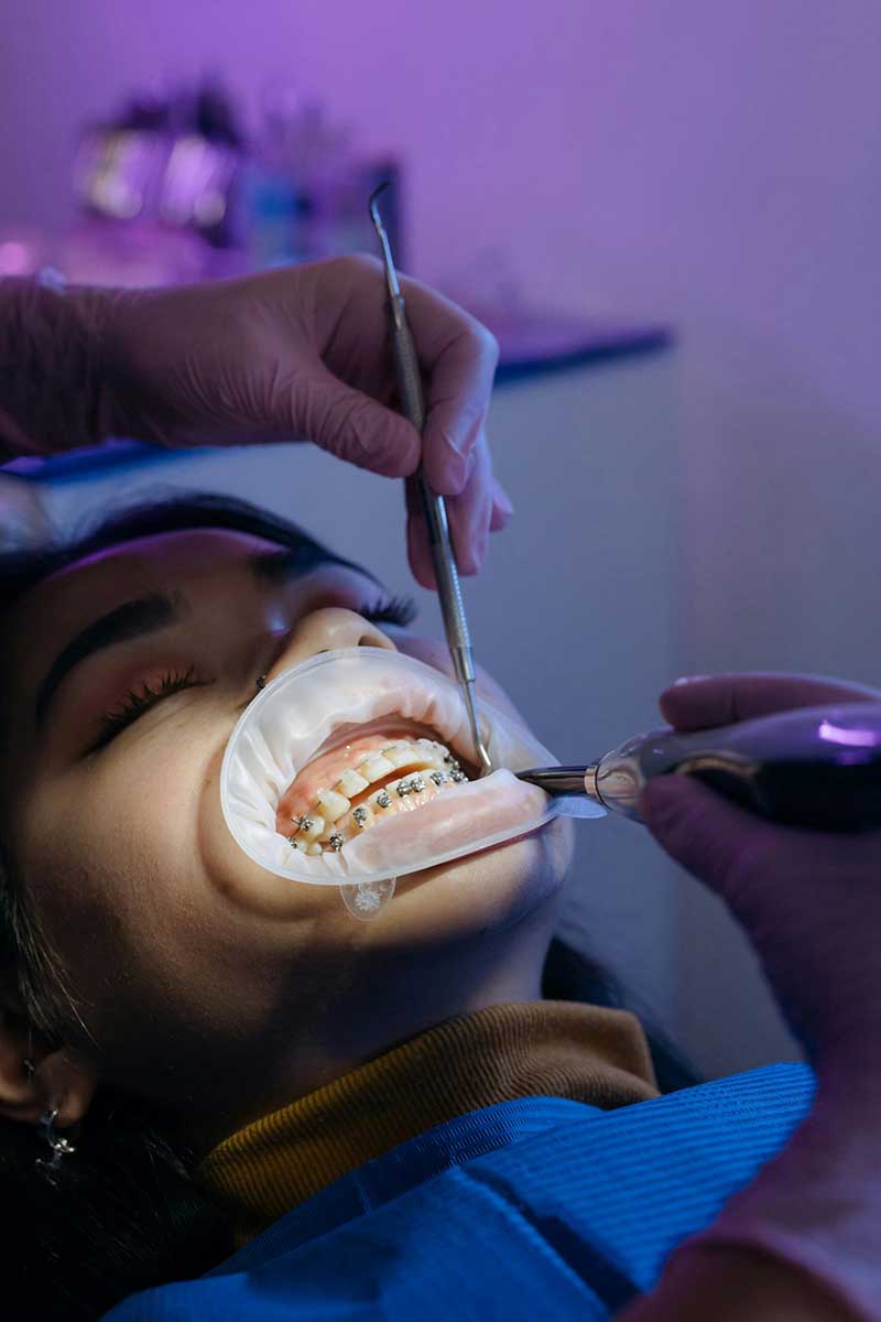 Can You Get Your Teeth Cleaned with Braces? A Complete Guide