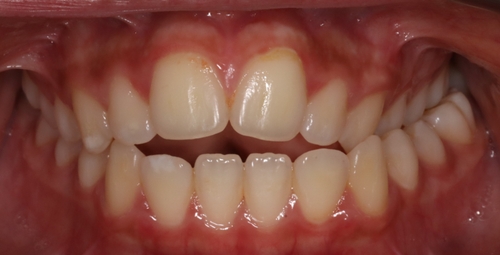 crossbite-openbite-expander-braces-invisalign-angel-aligners