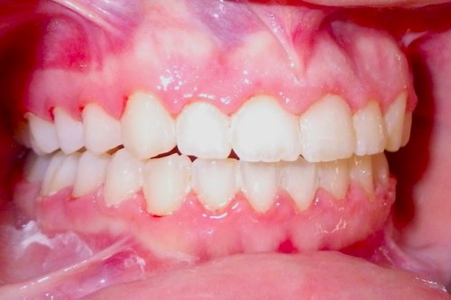 Swollen Gums with Braces