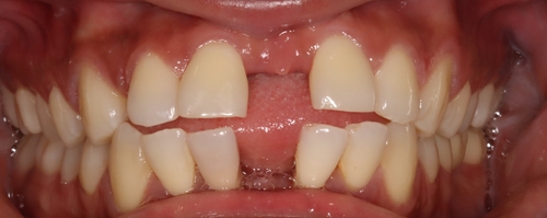 gaps-spacing-diastema