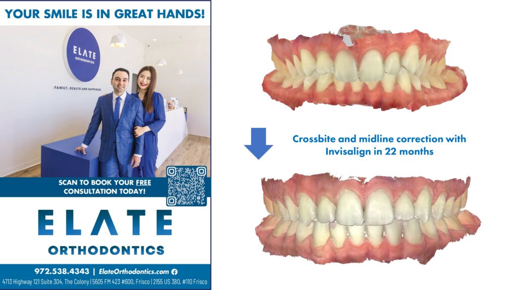 Midline Correction Before and After