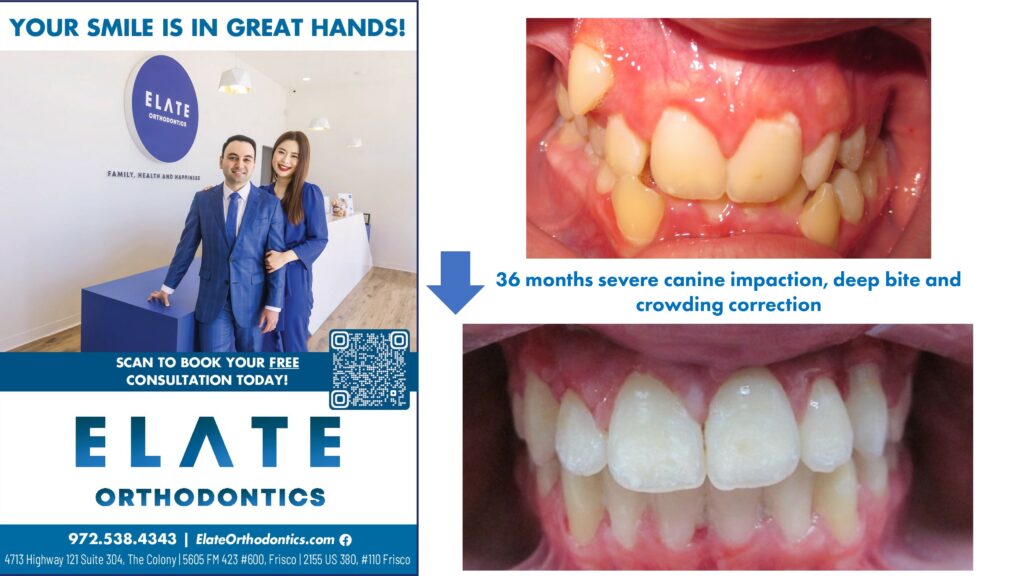 Canine Impaction Before and After