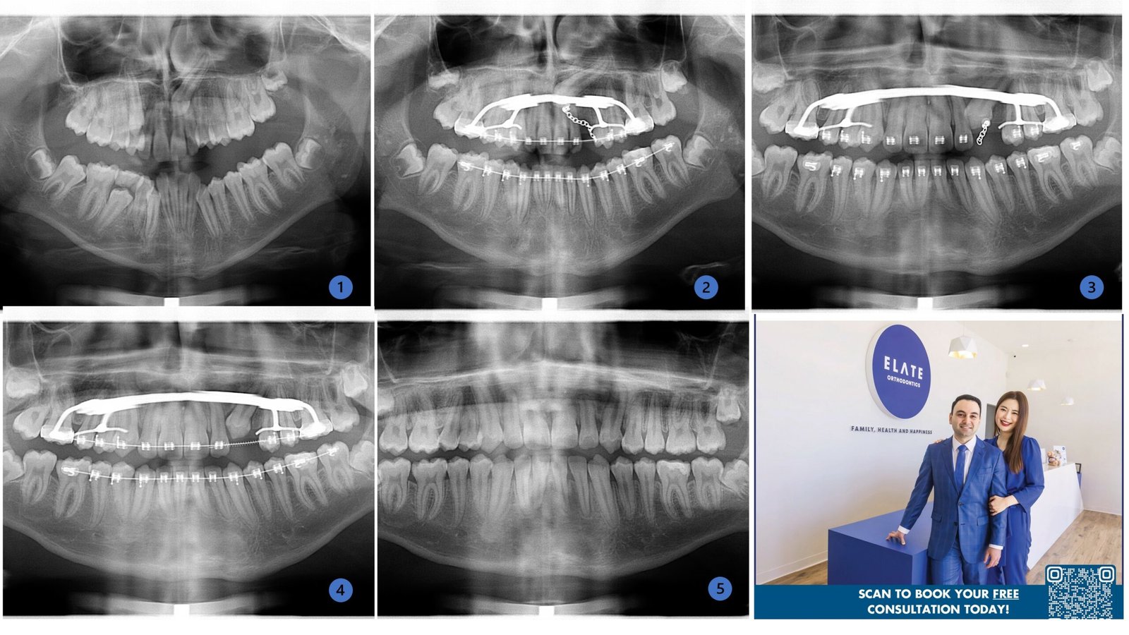 Canine impaction panoramic X-ray series showing palatal expander and gold chain traction at Elate Orthodontics Frisco TX