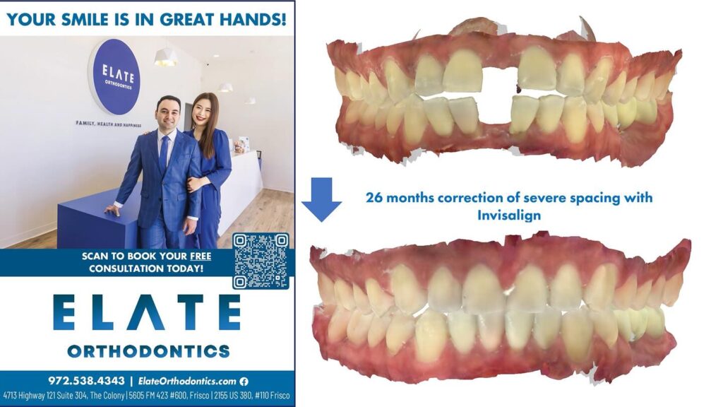 Gapped teeth before and after Invisalign