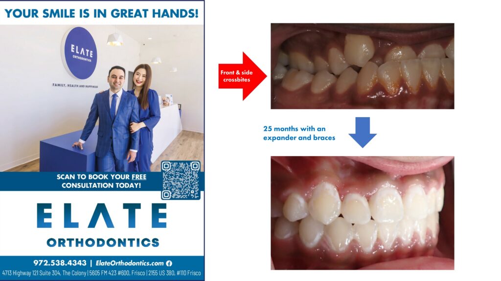 Underbite before and after