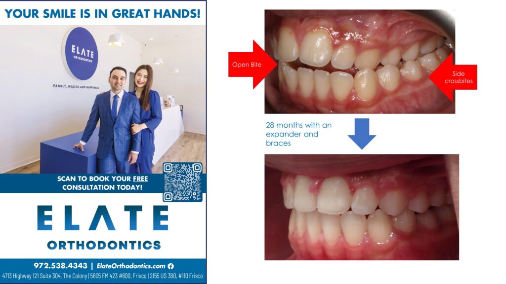 Crossbite Correction Before and After