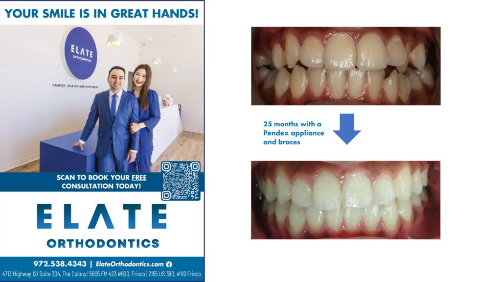 crowding Elate Orthodontics