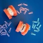 Clear ceramic braces in Frisco TX