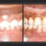 Gingivectomy gum recontouring
