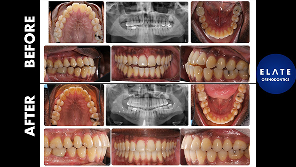 Before and After Jaw Surgery