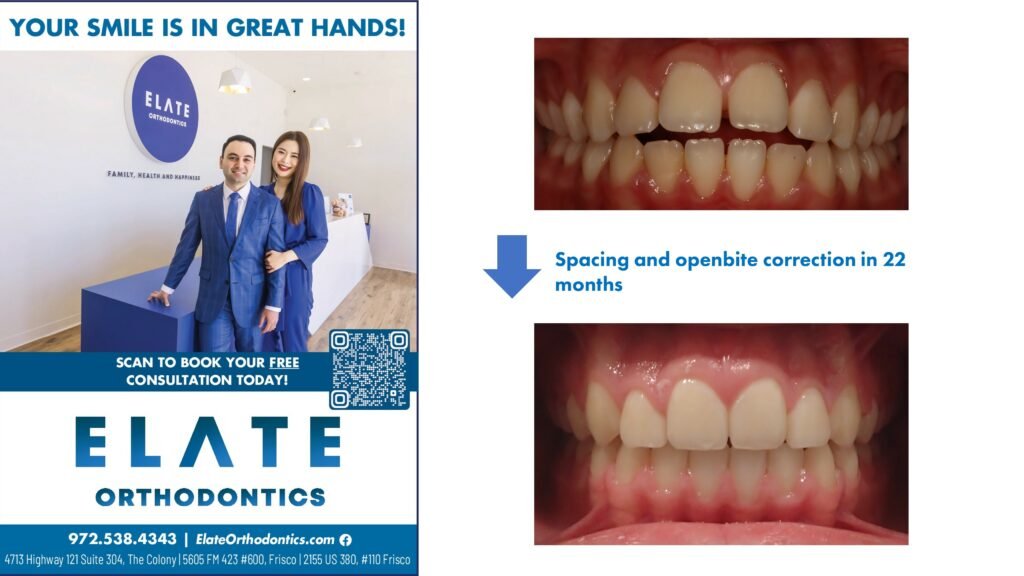 Spacing correction by the best Invisalign dentist in Frisco TX 2025