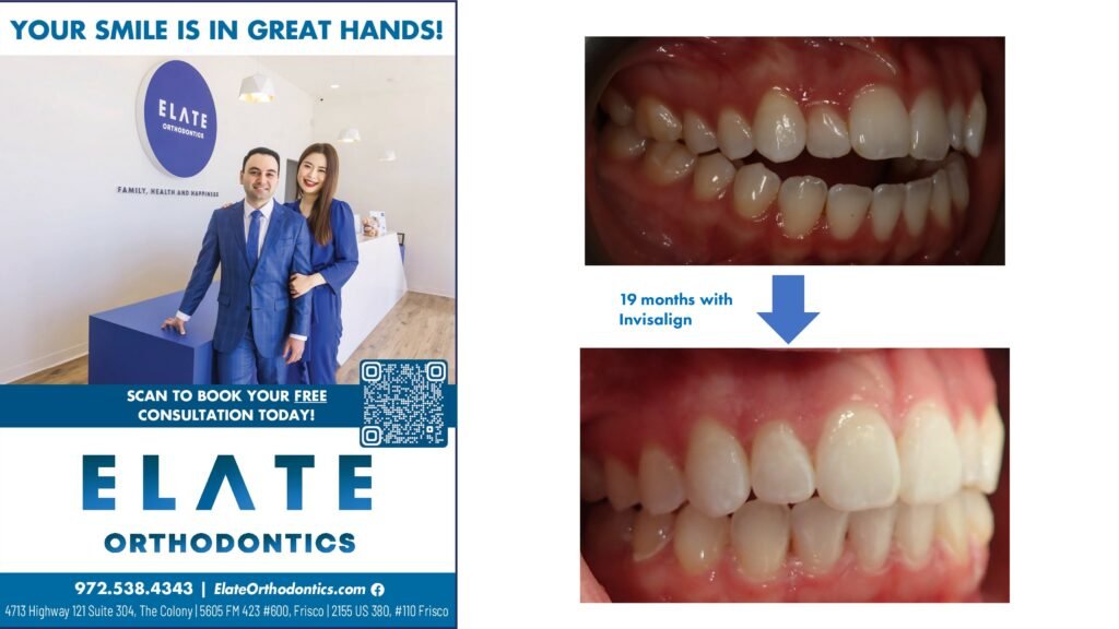 Open bite correction by the best Invisalign dentist in Frisco TX