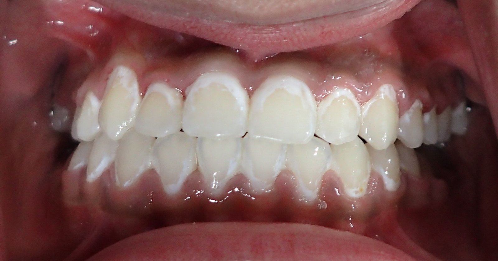 White Spots on Teeth from Braces – Causes, Prevention & Treatment