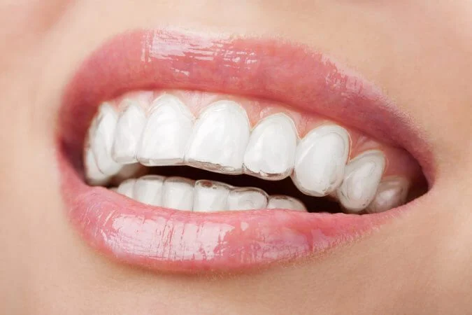 Teen wearing clear aligners in Frisco TX at Elate Orthodontics