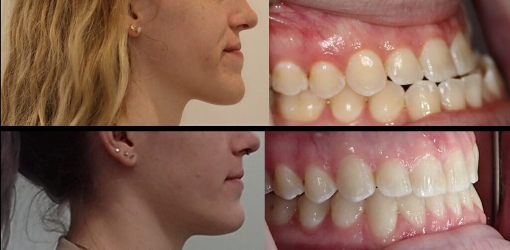 Before and after orthodontic treatment using clear aligners combined with orthognathic surgery to correct underbite, open bite, and posterior crossbite at Elate Orthodontics in Frisco and The Colony