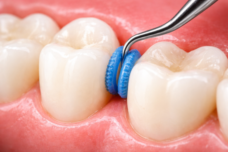 Orthodontic spacers placed between back teeth at Elate Orthodontics in Frisco and The Colony TX