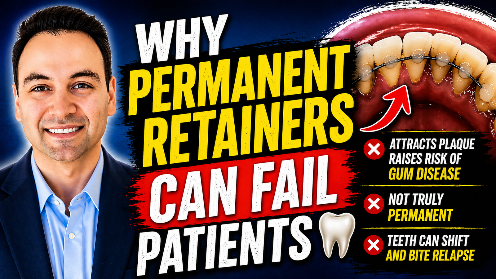 Permanent Retainers can fail