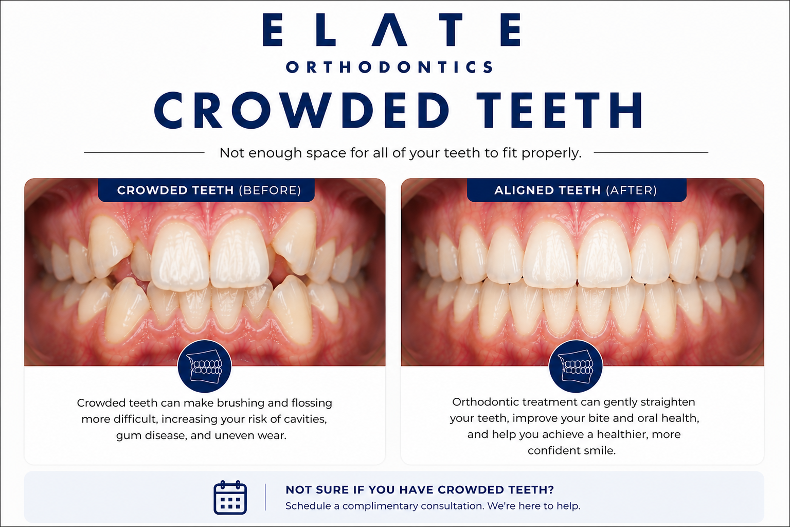 Crowded teeth correction at Elate Orthodontics in Frisco and The Colony TX with palatal expander braces and clear aligners