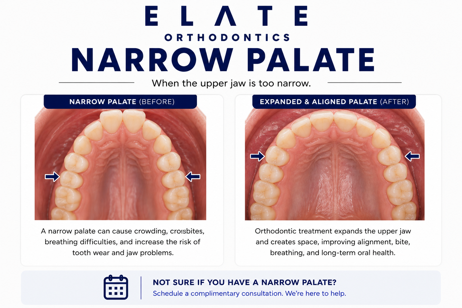Narrow palate correction at Elate Orthodontics in Frisco and The Colony TX with palatal expansion and arch development