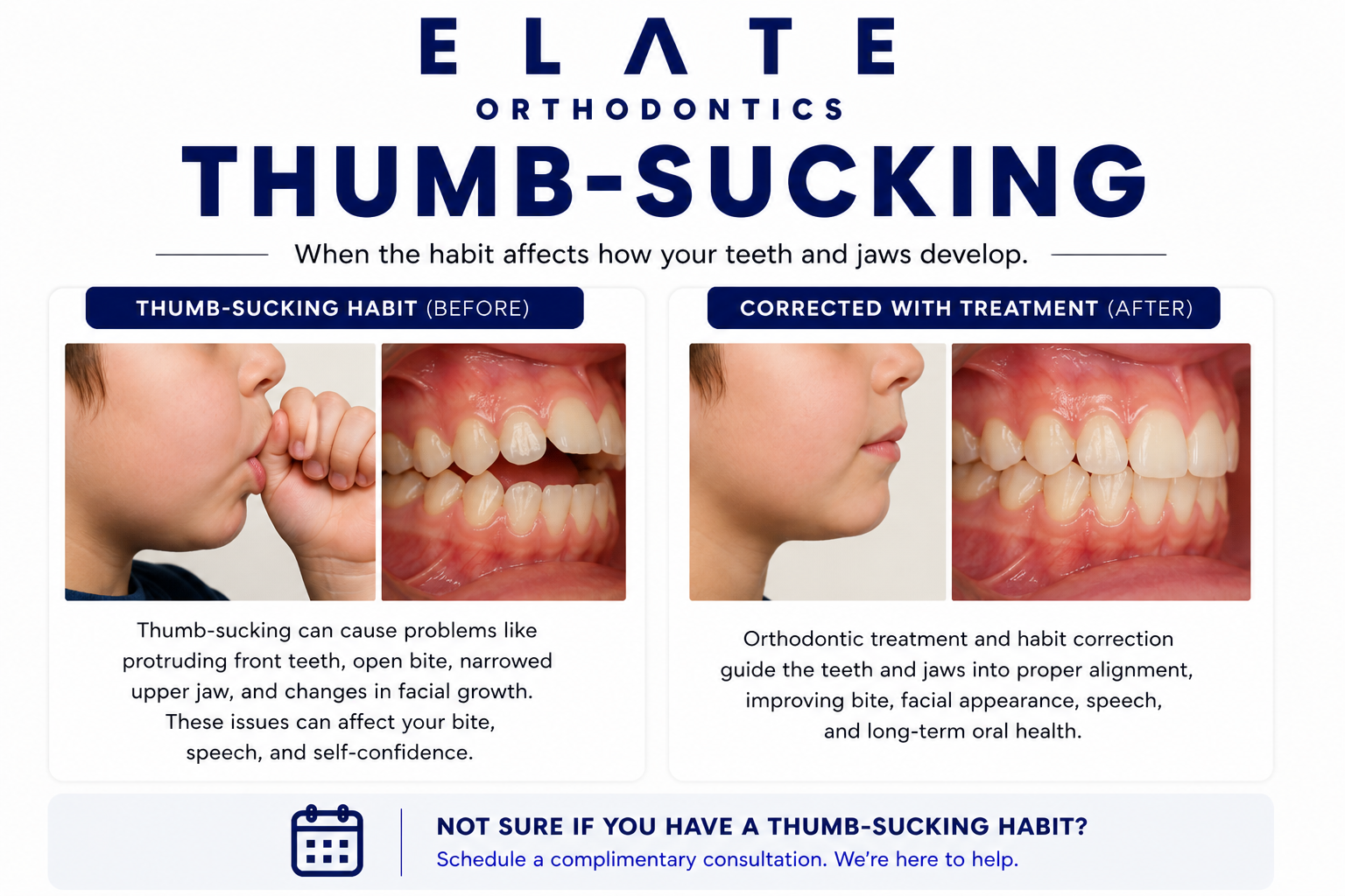 Thumb sucking effects treatment at Elate Orthodontics in Frisco and The Colony TX with habit appliances and comprehensive orthodontics