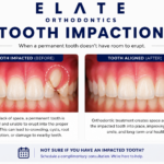 Impacted tooth correction case treated at Elate Orthodontics in Frisco TX