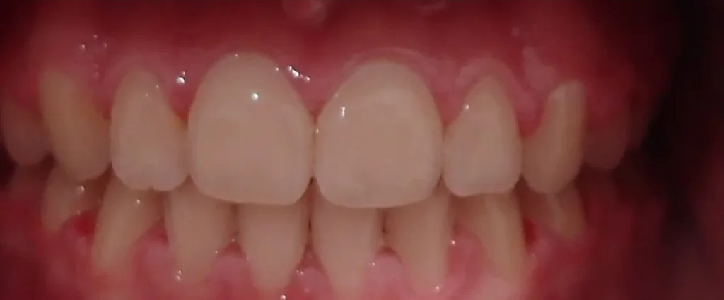 Crossbite treated with expander and braces after orthodontic treatment at Elate Orthodontics, case 3462