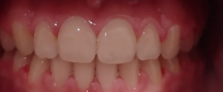 Crossbite treated with expander and braces after orthodontic treatment at Elate Orthodontics, case 3462