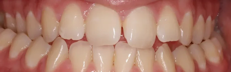 Crossbite treated with expander and braces before orthodontic treatment at Elate Orthodontics, case 3462