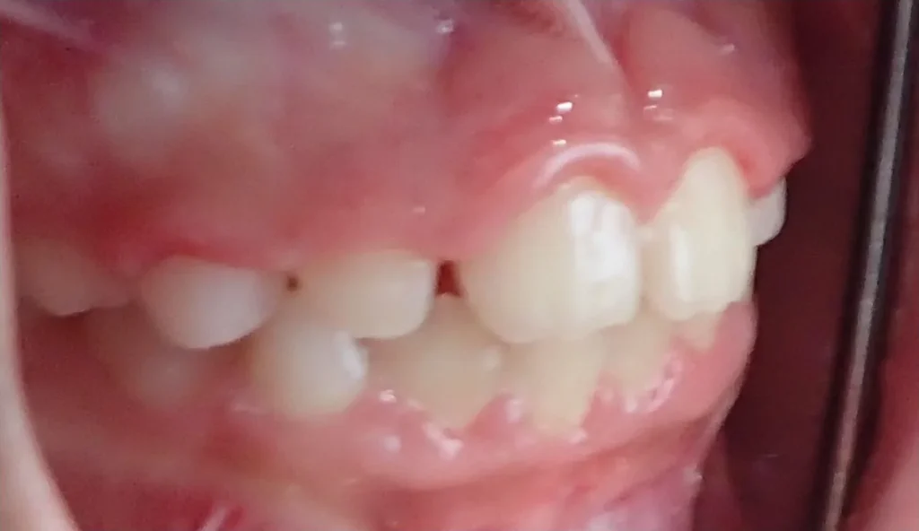Crossbite treated with braces after orthodontic treatment at Elate Orthodontics, case 3490