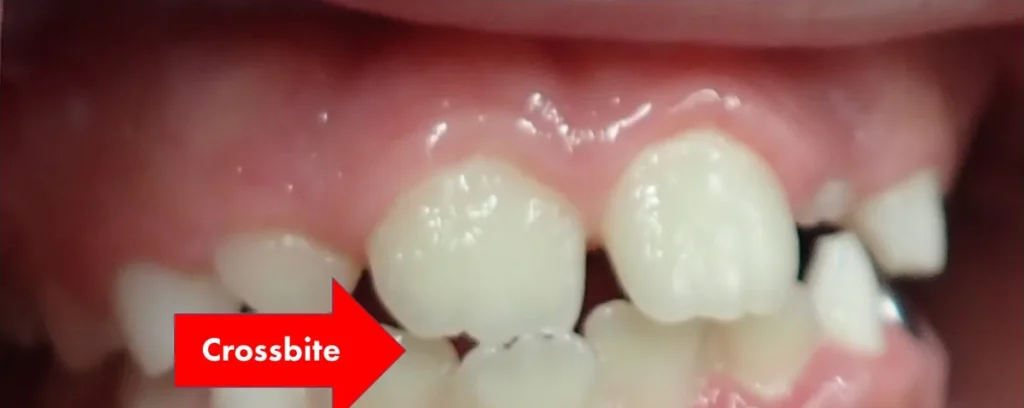 Crossbite treated with braces before orthodontic treatment at Elate Orthodontics, case 3490