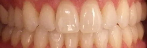 Crossbite and Crowded Teeth treated with clear aligners after orthodontic treatment at Elate Orthodontics, case 3574