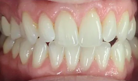 Crossbite and Crowded Teeth treated with clear aligners before orthodontic treatment at Elate Orthodontics, case 3574