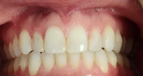 Crossbite and Crowded Teeth treated with clear aligners after orthodontic treatment at Elate Orthodontics, case 4076