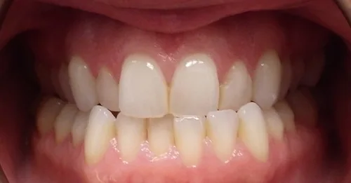 Crossbite and Crowded Teeth treated with clear aligners before orthodontic treatment at Elate Orthodontics, case 4076