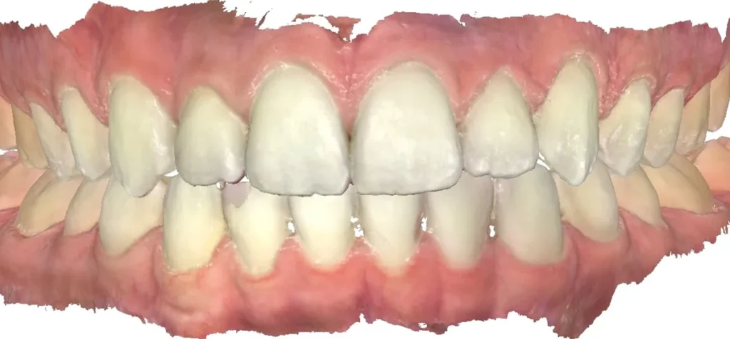 Crossbite and Midline Shift treated with clear aligners after orthodontic treatment at Elate Orthodontics, case 3450