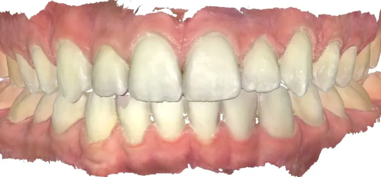 Crossbite and Midline Shift treated with clear aligners after orthodontic treatment at Elate Orthodontics, case 3450