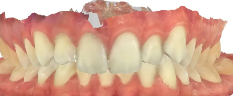 Crossbite and Midline Shift treated with clear aligners before orthodontic treatment at Elate Orthodontics, case 3450