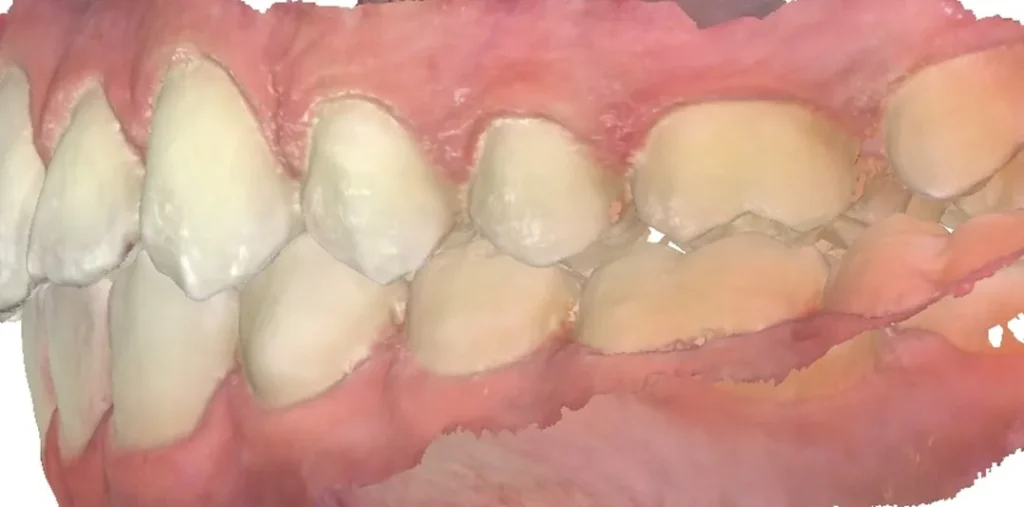 Crossbite and Midline Shift treated with clear aligners after orthodontic treatment at Elate Orthodontics, case 3454