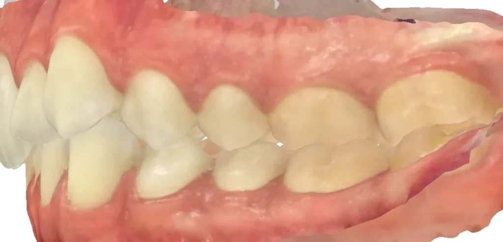Crossbite and Midline Shift treated with clear aligners before orthodontic treatment at Elate Orthodontics, case 3454