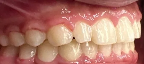 Crossbite and Overbite treated with braces after orthodontic treatment at Elate Orthodontics, case 3880