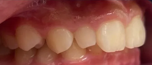 Crossbite and Overbite treated with braces before orthodontic treatment at Elate Orthodontics, case 3880