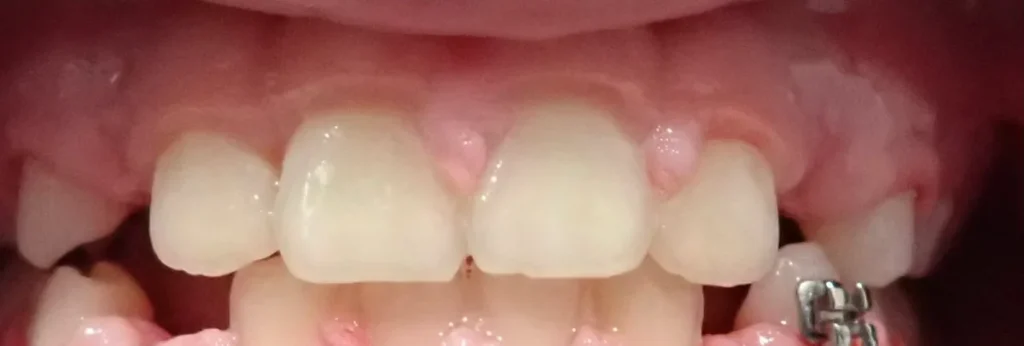 Crossbite and Underbite treated with expander, braces and early treatment (phase i) after orthodontic treatment at Elate Orthodontics, case 3458