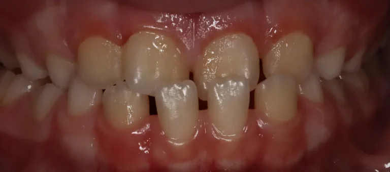 Crossbite and Underbite treated with expander, braces and early treatment (phase i) before orthodontic treatment at Elate Orthodontics, case 3458