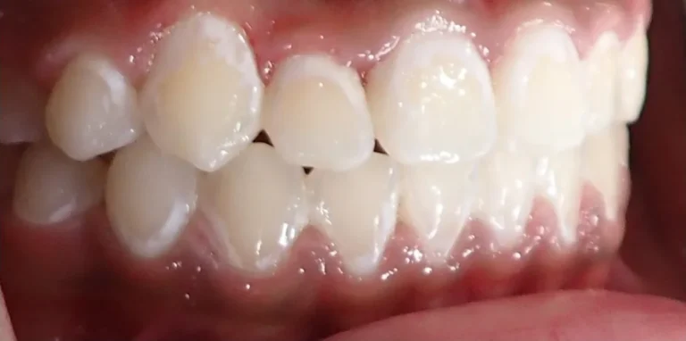 Crossbite and Underbite treated with expander and braces after orthodontic treatment at Elate Orthodontics, case 3498
