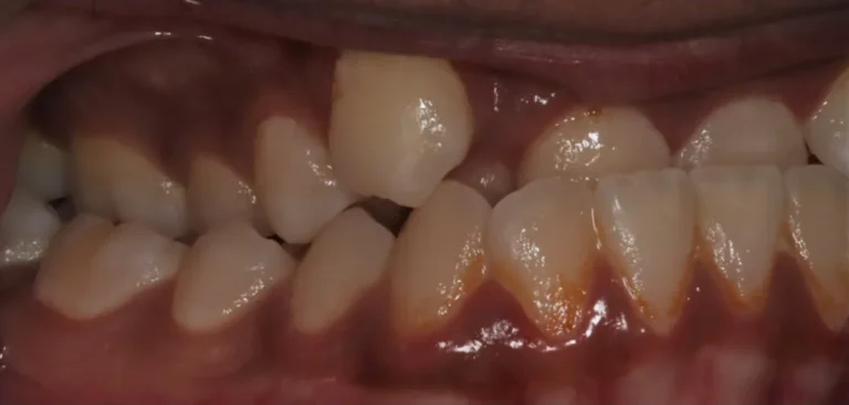 Crossbite and Underbite treated with expander and braces before orthodontic treatment at Elate Orthodontics, case 3498